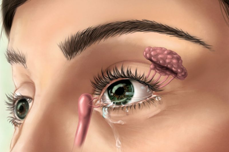 Obstrução da Via Lacrimal